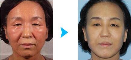 韩国乐世里LUXELL整形医院面部抗衰老对比图