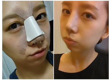 韩国术后美护：隆鼻“超实用”护理恢复注意事项