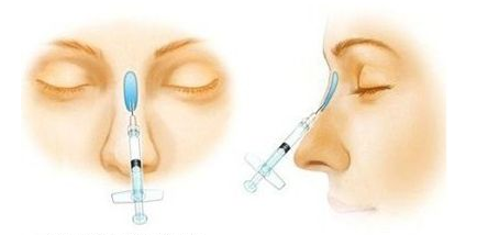 玻尿酸隆鼻手术示意图
