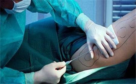 韩国美护支招：吸脂术后恢复过程护理指南