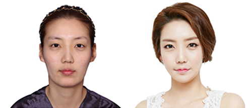 韩国女神医院下颌角整形案例