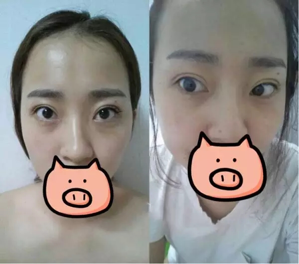 韩国美护顾客分享：清潭优眼鼻整形术后恢复
