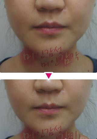 韩国美感整形医院瘦咬肌对比图