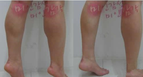 韩国美感整形医院注射瘦腿对比图