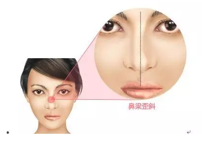 隆鼻技术不佳或导致鼻梁歪斜