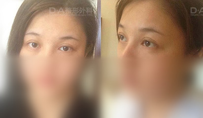 韩国DA医院双眼皮术前照片展示