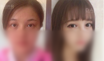 韩国DA医院双眼皮手术对比