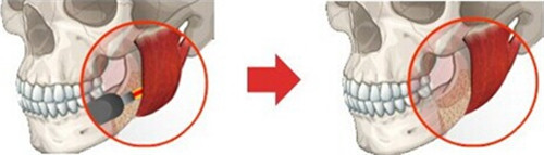 韩国巴诺巴奇下颌角整形示意图