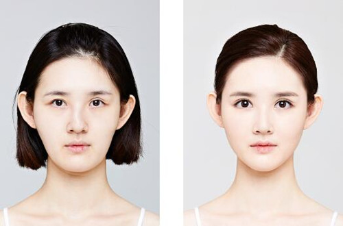 韩国CLAIR整形外科歪鼻矫正对比图