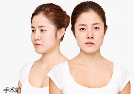 韩国CLAIR整形外科面部轮廓整形术前