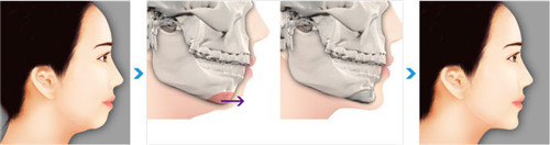 双鄂畸形导致的下巴后缩如何改善