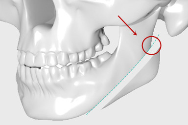 传统下颌角手术弊端有哪些