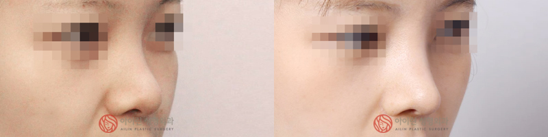 韩国爱琳整形医院短鼻矫正案例图