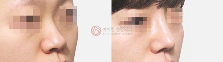 韩国爱琳整形医院歪鼻矫正对比案例图片