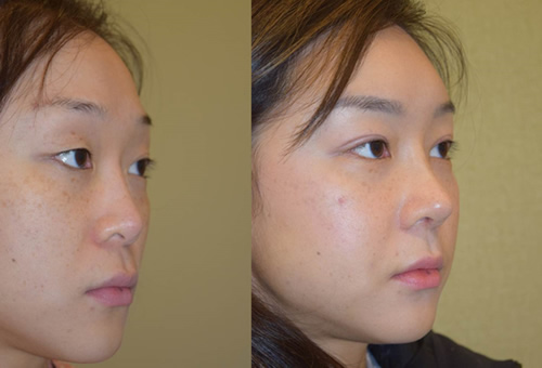 韩国可安美整形外科隆鼻风格分析