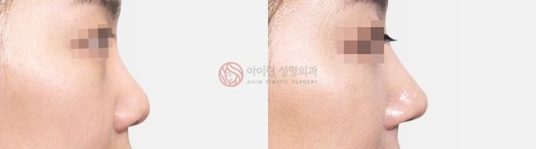 韩国爱琳整形医院短鼻矫正案例图