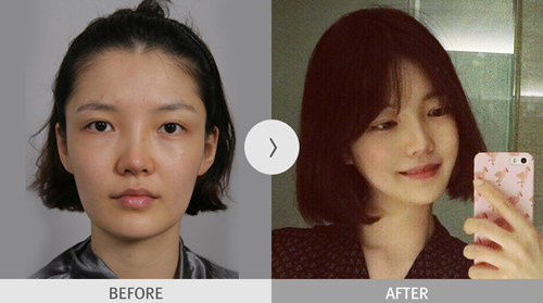 韩国麦恩整形外科下颌角手术对比
