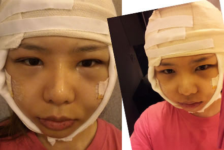 在欧佩拉整形外科做了面部轮廓整形手术