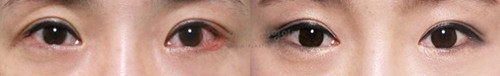 爱琳整形外科眼睛凹陷矫正对比图