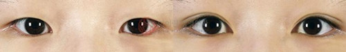 爱琳整形外科开眼角+埋线双眼皮对比图