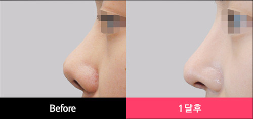 韩国Yerom整形外科隆鼻对比案例图