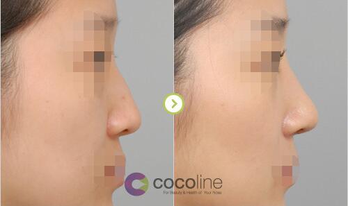 cocoline整形医院无假体隆鼻对比图