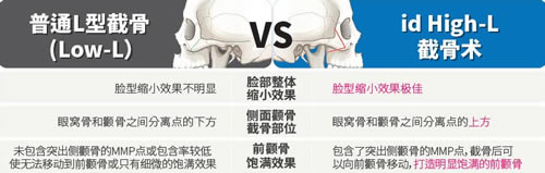韩国id整形外科颧骨手术优势对比