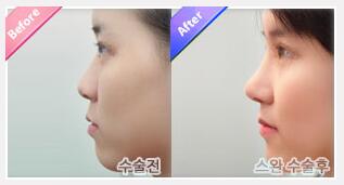 韩国天鹅整形外科隆鼻手术对比图