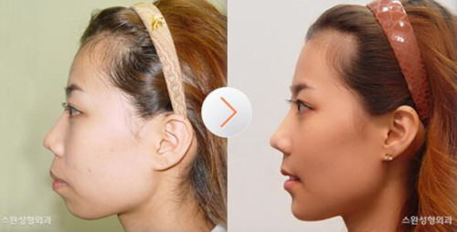 韩国天鹅整形外科双颚手术对比图