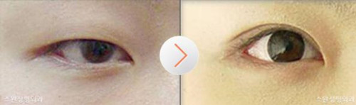 韩国天鹅整形外科双眼皮手术对比图