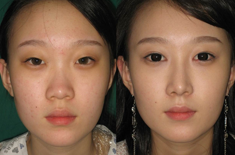 韩国CNMcoanmi外科双眼皮案例