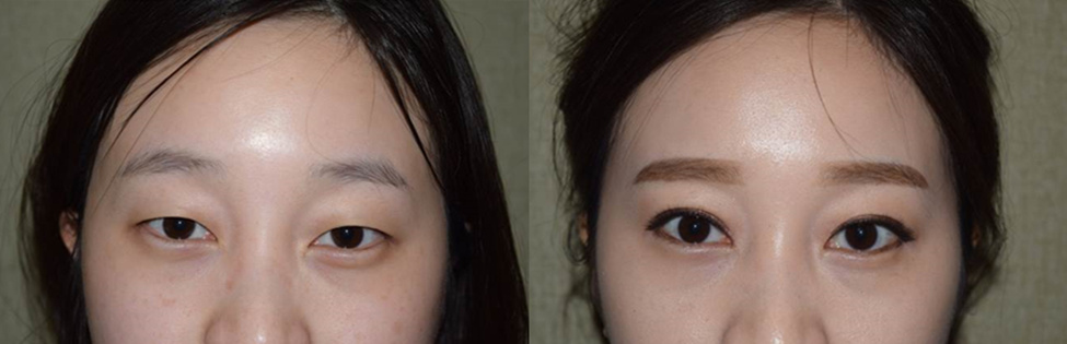 韩国CNM（COANMI）整形外科医院双眼皮案例对比图