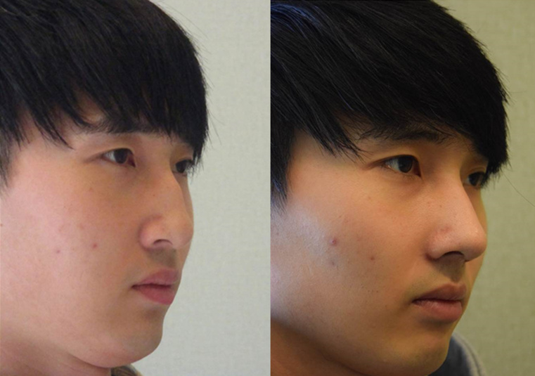 韩国可安美（CNM）整形外科鼻子矫正