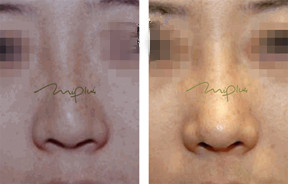 韩国美Plus整形外科自体软骨隆鼻案例图