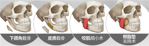 韩国巴诺巴奇下颌角整形日记下颌角整形示意图