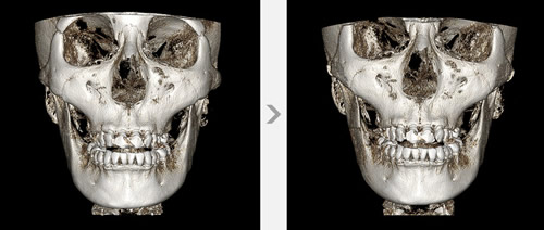 美迪莹医院无金属颧骨缩小CT对比