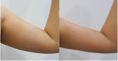 韩国延世YB整形外科手臂吸脂对比案例