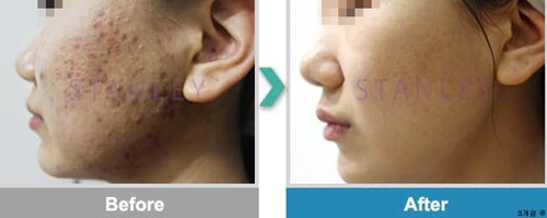 韩国史丹利整形医院痤疮皮肤治疗对比图