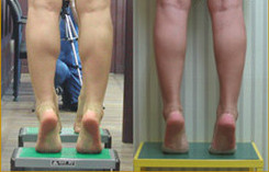 韩国美人整形外科瘦小腿对比案例