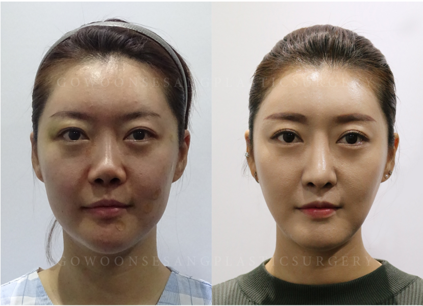 韩国德丽珍整形外科鼻子修复对比图