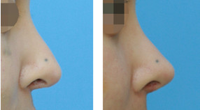 韩国COCOA整形外科隆鼻案例图