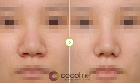 cocoline医院鼻头鼻翼缩小对比图