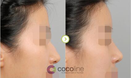 cocoline额鼻手术对比图