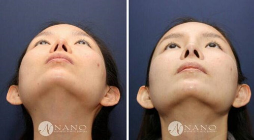 NANO整形外科肋软骨隆鼻修复对比图-仰面