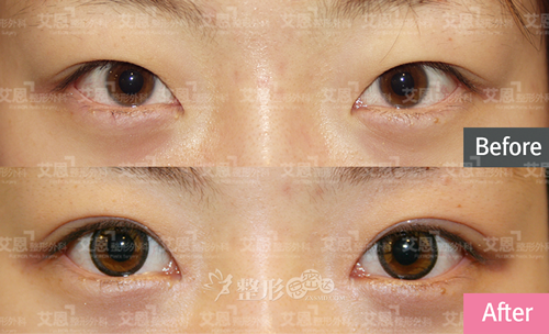 韩国艾恩整形外科埋线双眼皮对比