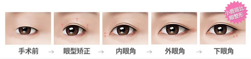 韩国ID双眼皮整形示意图