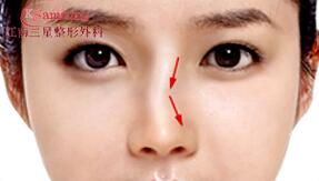 江南三星和4月31日：隆鼻修复手术怎么做？