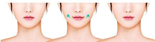韩国女神医院微笑唇手术优势及日记分享