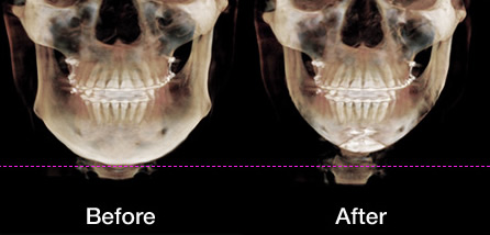 博朗温整形外科轮廓术后CT照片对比