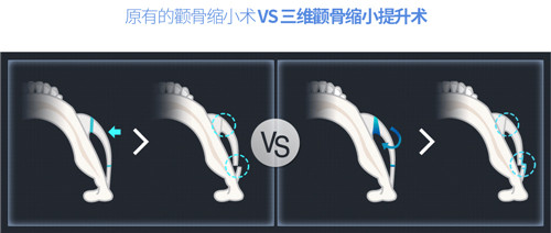 韩国TL颧骨缩小手术方法对比